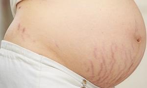 photo-of-pregnancy-stretch-marks.jpg