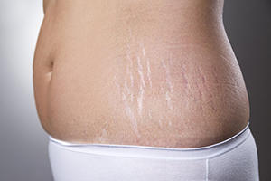 stretchmark.jpg