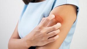 photo-of-woman-with-ringworm.jpg