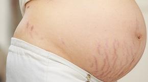 pregnant-woman-with-stretch-marks.jpg