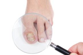 foot-with-nail-fungus.jpg
